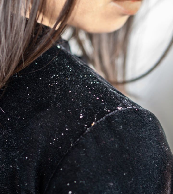 Ditch the Flakes:Guide to Choosing the Best Shampoo for Dandruff